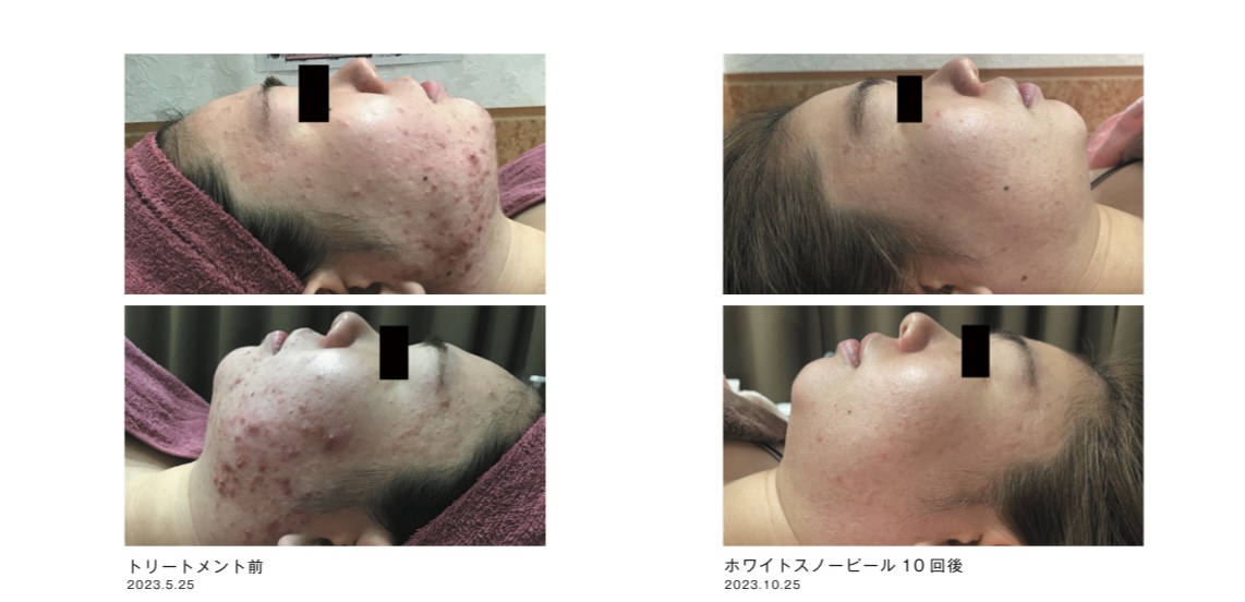 スノーピール施術例1